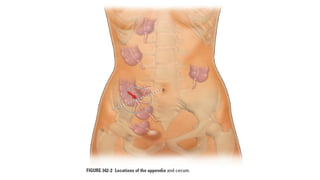 Acute APPENDICITIS internal medicine .pptx