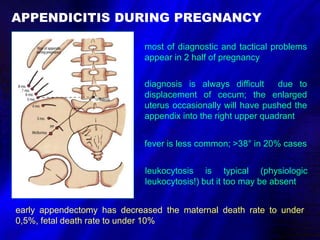 Appendicitis DELV.ppt