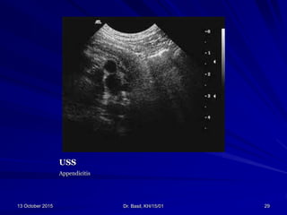 Appendicitis dr. basil tumaini | PPTX