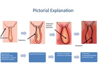 Pictorial Explanation
Appendiceal
obstruction/early
appendicitis – visceral
peritoneal irritation
Appendiceal distension Irritation of parietal
peritoneum (localised)
Perforation,
localised/generalised
peritonitis, mass
obstruction
Distention
mucus
Distention
causing
Ischemia
Gangrene
 
