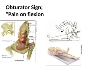 Obturator Sign;
“Pain on flexion and rotation
 