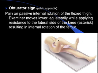 Obturator sign (pelvic appendix) 
Pain on passive internal rotation of the flexed thigh. Examiner moves lower leg laterally while applying resistance to the lateral side of the knee (asterisk) resulting in internal rotation of the femur. 
Aboubakr Elnashar  