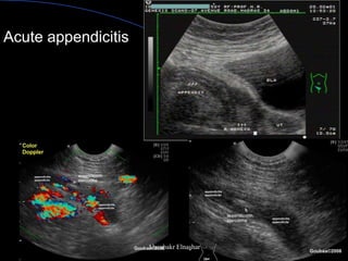 Acute appendicitis 
Aboubakr Elnashar  