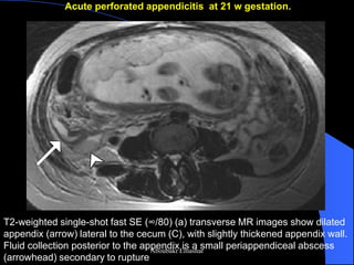 Acute perforated appendicitis at 21 w gestation. 
T2-weighted single-shot fast SE (∞/80) (a) transverse MR images show dilated appendix (arrow) lateral to the cecum (C), with slightly thickened appendix wall. Fluid collection posterior to the appendix is a small periappendiceal abscess (arrowhead) secondary to rupture 
Aboubakr Elnashar  