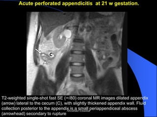 Acute perforated appendicitis at 21 w gestation. 
T2-weighted single-shot fast SE (∞/80) coronal MR images dilated appendix (arrow) lateral to the cecum (C), with slightly thickened appendix wall. Fluid collection posterior to the appendix is a small periappendiceal abscess (arrowhead) secondary to rupture 
Aboubakr Elnashar  