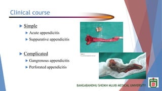 BANGABANDHU SHEIKH MUJIB MEDICAL UNIVERSITY
Clinical course
 Simple
 Acute appendicitis
 Suppurative appendicitis
 Complicated
 Gangrenous appendicitis
 Perforated appendicitis
 
