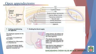 BANGABANDHU SHEIKH MUJIB MEDICAL UNIVERSITY
Open appendectomy
 