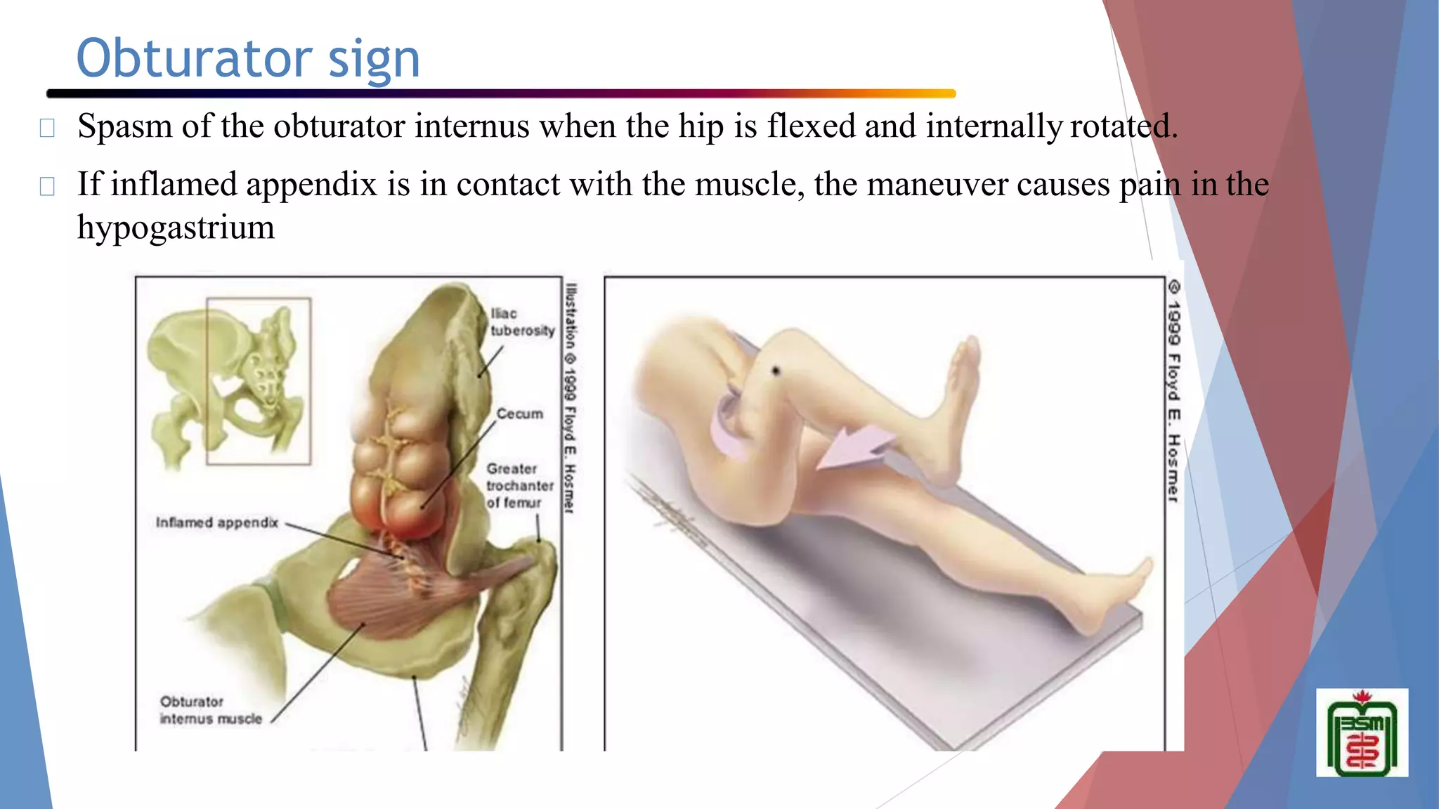 Appendicitis in children-.pptx