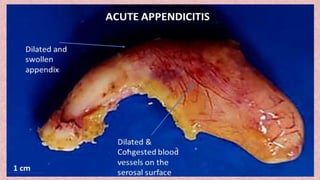 Diagnosis and Management of Acute Appendicitis in Children.pptx