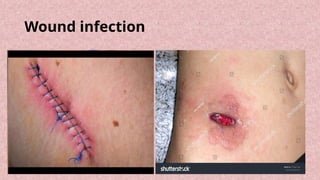 Diagnosis and Management of Acute Appendicitis in Children.pptx