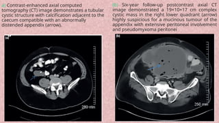 Diagnosis and Management of Acute Appendicitis in Children.pptx