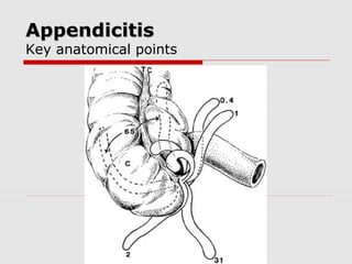 AppendicitisAppendicitis
Key anatomical points
 