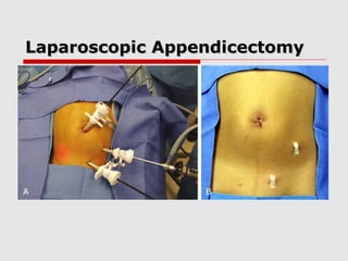 Laparoscopic AppendicectomyLaparoscopic Appendicectomy
 