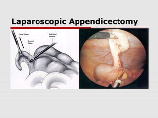 Laparoscopic AppendicectomyLaparoscopic Appendicectomy
 
