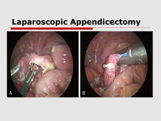 Laparoscopic AppendicectomyLaparoscopic Appendicectomy
 