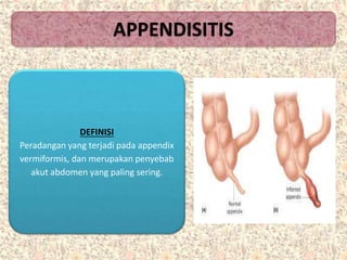 APPENDISITIS
DEFINISI
Peradangan yang terjadi pada appendix
vermiformis, dan merupakan penyebab
akut abdomen yang paling sering.
 