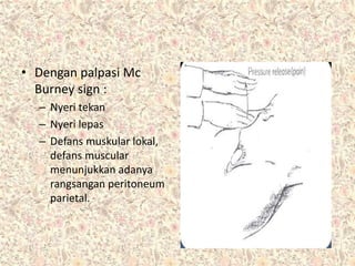 • Dengan palpasi Mc
Burney sign :
– Nyeri tekan
– Nyeri lepas
– Defans muskular lokal,
defans muscular
menunjukkan adanya
rangsangan peritoneum
parietal.
 