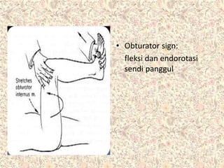 • Obturator sign:
fleksi dan endorotasi
sendi panggul
 