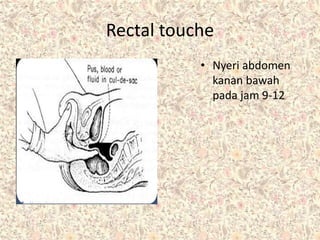 Rectal touche
• Nyeri abdomen
kanan bawah
pada jam 9-12
 