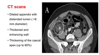 Normal Appendix Dilation Appendicitis | PPTX