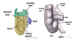 Appendicitis | PPTX