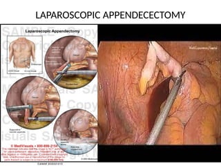 ACUTE APPENDICITIS PPT [Autosaved].pptx