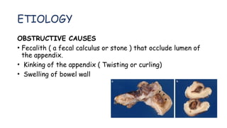 ETIOLOGY
OBSTRUCTIVE CAUSES
• Fecalith ( a fecal calculus or stone ) that occlude lumen of
the appendix.
• Kinking of the appendix ( Twisting or curling)
• Swelling of bowel wall
 