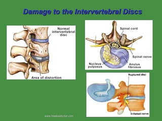 Damage to the Intervertebral Discs www.freelivedoctor.com  
