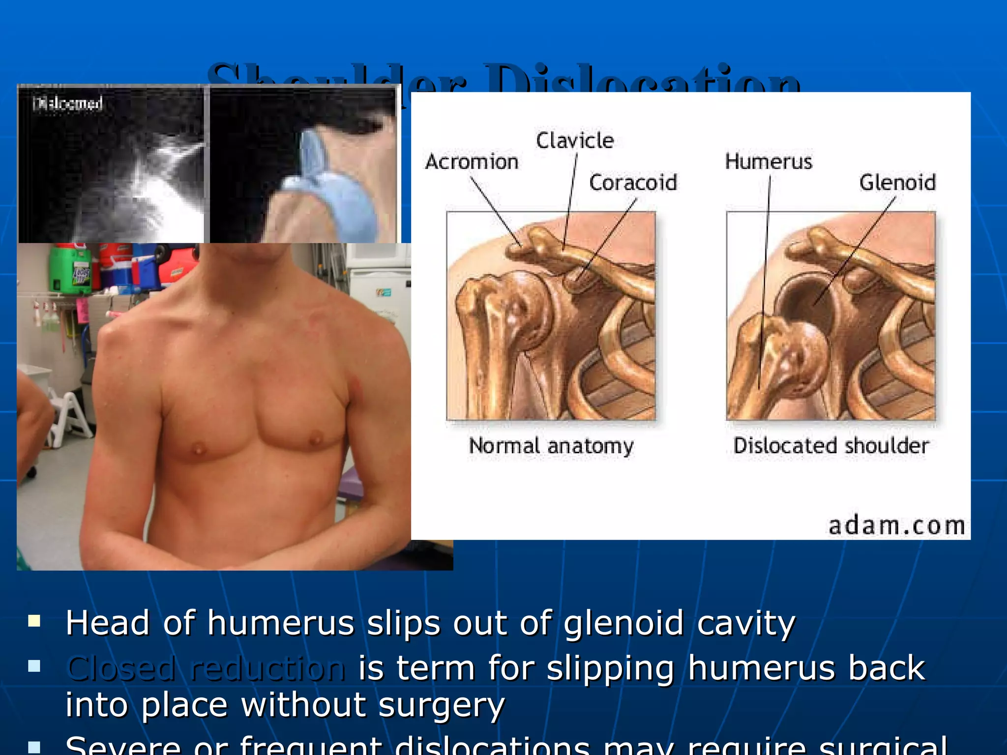 Shoulder Dislocation Head of humerus slips out of glenoid cavity Closed reduction   is term for slipping humerus back into place without surgery Severe or frequent dislocations may require surgical ligament repair 