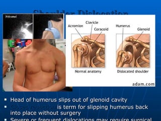 Shoulder Dislocation Head of humerus slips out of glenoid cavity Closed reduction   is term for slipping humerus back into place without surgery Severe or frequent dislocations may require surgical ligament repair 