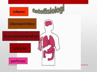 inflamsi
Ulserasi/infeksi
Supurasi/penanahan
gangren
perforasi
 