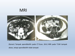 MRI
(Kanan) Tampak apendikolith pada CT-Scan, (Kiri) MRI pada T1WI tampak
abses, tetapi apendikolith tidak tampak
 
