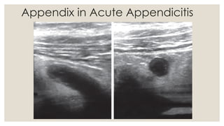 appendix and its diseases in detail for surgery | PPTX