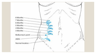 appendix and its diseases in detail for surgery | PPTX
