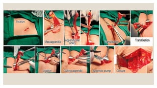 appendix and its diseases in detail for surgery | PPTX