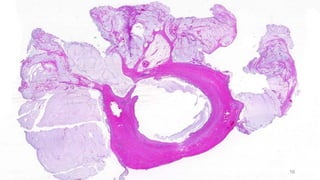 the LAMN and Goblet cell adenocarcinoma.pdf
