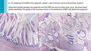Lamn Appendix Algorithm the LAMN and Goblet cell adenocarcinoma.pdf
