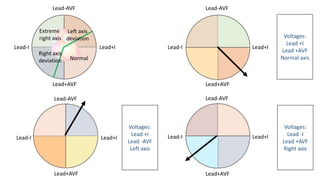 Lead-AVF
Lead-I Lead+I
Lead+AVF
Lead-AVF
Lead-I Lead+I
Lead+AVF
Lead-AVF
Lead-I Lead+I
Lead+AVF
Lead-AVF
Lead-I Lead+I
Lead+AVF
Voltages:
Lead +I
Lead +AVF
Normal axis
Voltages:
Lead +I
Lead -AVF
Left axis
Voltages:
Lead -I
Lead +AVF
Right axis
Extreme
right axis
Left axis
deviation
Right axis
deviation Normal
 