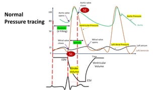 Normal
Pressure tracing 80
Diastole
(V Filling)
Systole
S1
S2
15
 