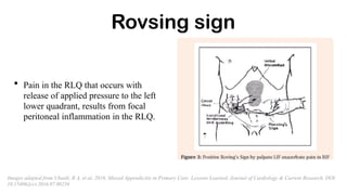 Rovsing sign
• Pain in the RLQ that occurs with
release of applied pressure to the left
lower quadrant, results from focal
peritoneal inflammation in the RLQ.
Images adapted from Ubaidi, B A, et al, 2016, Missed Appendicitis in Primary Care: Lessons Learned, Journal of Cardiology & Current Research, DOI:
10.15406/jccr.2016.07.00256
 