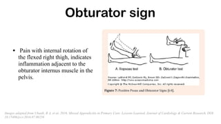 Obturator sign
• Pain with internal rotation of
the flexed right thigh, indicates
inflammation adjacent to the
obturator internus muscle in the
pelvis.
Images adapted from Ubaidi, B A, et al, 2016, Missed Appendicitis in Primary Care: Lessons Learned, Journal of Cardiology & Current Research, DOI:
10.15406/jccr.2016.07.00256
 