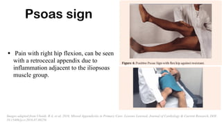 Psoas sign
• Pain with right hip flexion, can be seen
with a retrocecal appendix due to
inflammation adjacent to the iliopsoas
muscle group.
Images adapted from Ubaidi, B A, et al, 2016, Missed Appendicitis in Primary Care: Lessons Learned, Journal of Cardiology & Current Research, DOI:
10.15406/jccr.2016.07.00256
 