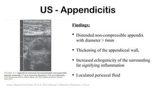 US - Appendicitis
Findings;
• Distended non-compressible appendix
with diameter > 6mm
• Thickening of the appendiceal wall,
• Increased echogenicity of the surrounding
fat signifying inflammation
• Loculated pericecal fluid
Image adapted from Zinner, M et al, 2019, Maingot's Abdominal Operations, 13th ed
 