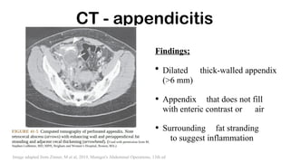 CT - appendicitis
Findings;
• Dilated thick-walled appendix
(>6 mm)
• Appendix that does not fill
with enteric contrast or air
• Surrounding fat stranding
to suggest inflammation
Image adapted from Zinner, M et al, 2019, Maingot's Abdominal Operations, 13th ed
 