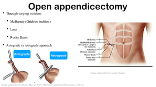 • Through varying incisions
• McBurney (Gridiron incision)
• Lanz
• Rocky Davis
• Antegrade vs retrograde approach
Open appendicectomy
Image adapted from Zinner, M et al, 2019, Maingot's Abdominal Operations, 13th ed
Antegrade Retrograde
Image adapted from Google Images
 