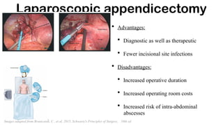 Laparoscopic appendicectomy
• Advantages:
• Diagnostic as well as therapeutic
• Fewer incisional site infections
• Disadvantages:
• Increased operative duration
• Increased operating room costs
• Increased risk of intra-abdominal
abscesses
Images adapted from Brunicardi, C , et al, 2015, Schwartz's Principles of Surgery, 10th ed
 