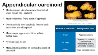 Appendicular carcinoid
• Most common site of carcinoid tumor (2nd -
small bowel, 3rd - rectum)
• Most commonly found at tip of appendix
• Do not usually have carcinoid features until
metastases are widespread
• Macroscopic appearance: firm, yellow,
bulbar mass
• Average size: 2.5 cm
• Management depends on size and location of
carcinoid
Feature of carcinoid Management tenet
< 1cm
1 - 2 cm
> 2cm
Appendicectomy
Depends on location,
presence of
mesenteric spread,
lymphatic invasion
Right hemicolectomy
Image adapted from COSECSA module
 