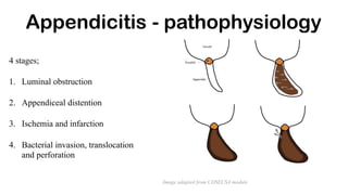 4 stages;
1. Luminal obstruction
2. Appendiceal distention
3. Ischemia and infarction
4. Bacterial invasion, translocation
and perforation
Appendicitis - pathophysiology
Image adapted from COSECSA module
 