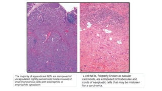 APPENDIX SLIDE – BENIGN ^0 MALIGNANT.pptx