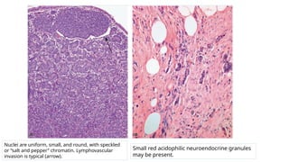 APPENDIX SLIDE – BENIGN ^0 MALIGNANT.pptx